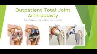 Same Day Joint Replacement - Webinar Recording