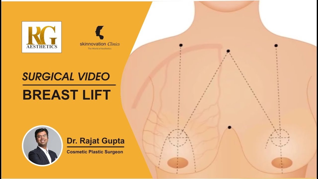 Breast Reduction Surgery Procedure & Postoperative Care - Dr. Rajat Gupta