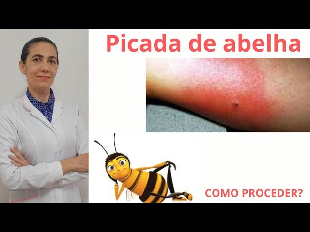 Reacao Alergica A Picada De Abelha Especialistas Alertam Para Ataques