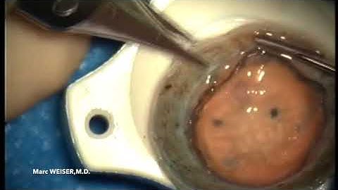 DMEK endothelial graft