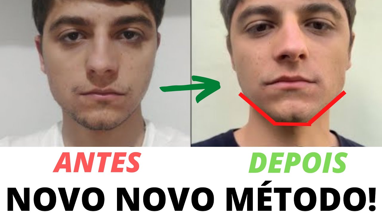 Mewing Antes E Depois | Golden Jaw Treino Mandibula Funciona