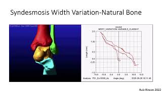 FFAFS: "Importance of Syndesmotic Stability in TAR", 4/27/23 screenshot 2