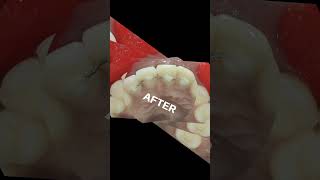 Say no to Smoking! Say no to Smoking stains! #dentalprocedure #sandblaster #satisfying #dentist