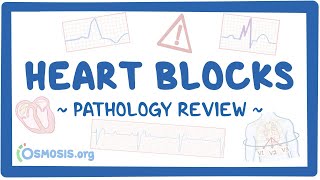 Heart blocks: Pathology Review
