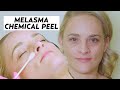 Jessner Peel: An Effective Melasma Treatment!! | #MAKEOVER