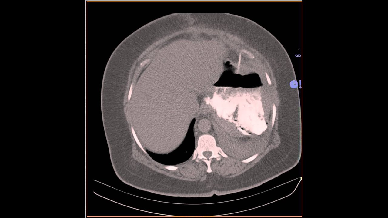 sleeve gastrectomy CT leak YouTube
