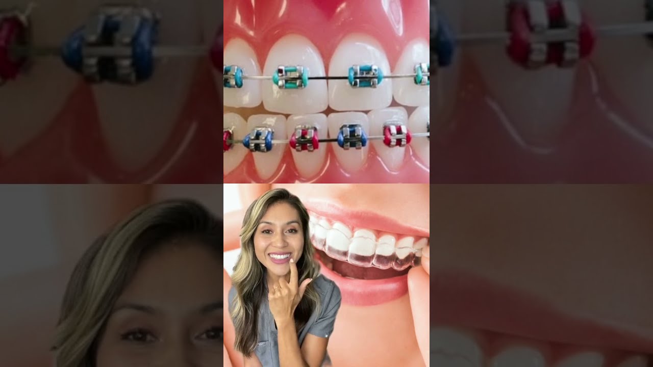 Pros And Cons Of Braces Vs Invisalign