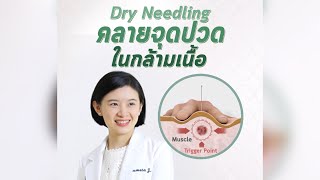 Dry Needling การลงหรือฝังเข็มคลายจุดปวดกล้ามเนื้อ