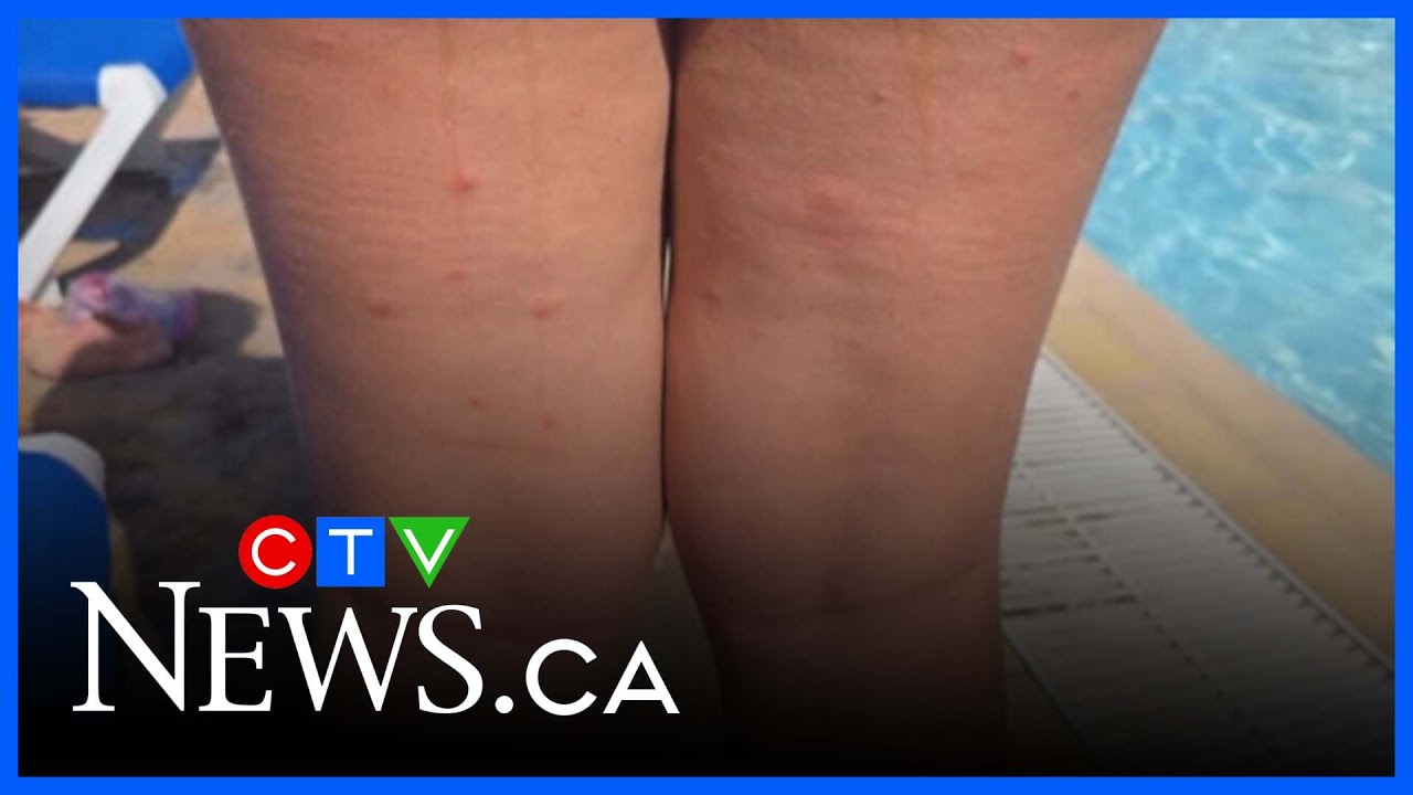Family's Cuban vacation turns to bed-bug ridden nightmare - YouTube