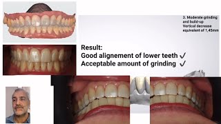 Canine guidance or Group function - is it relevant 