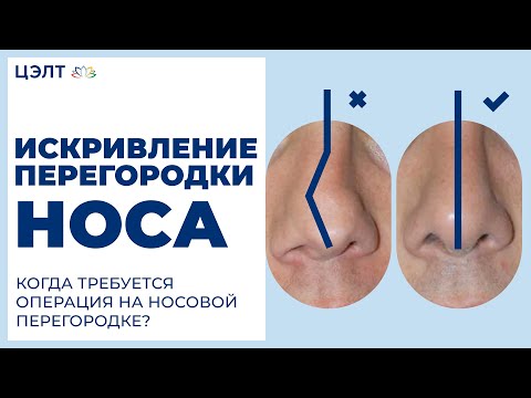 Искривление перегородки носа. Когда требуется операция на носовой перегородке? ЦЭЛТ.