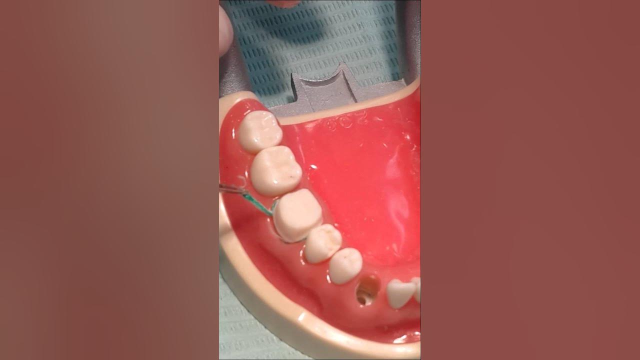 Retraction Cord placment + Final Impressions YouTube