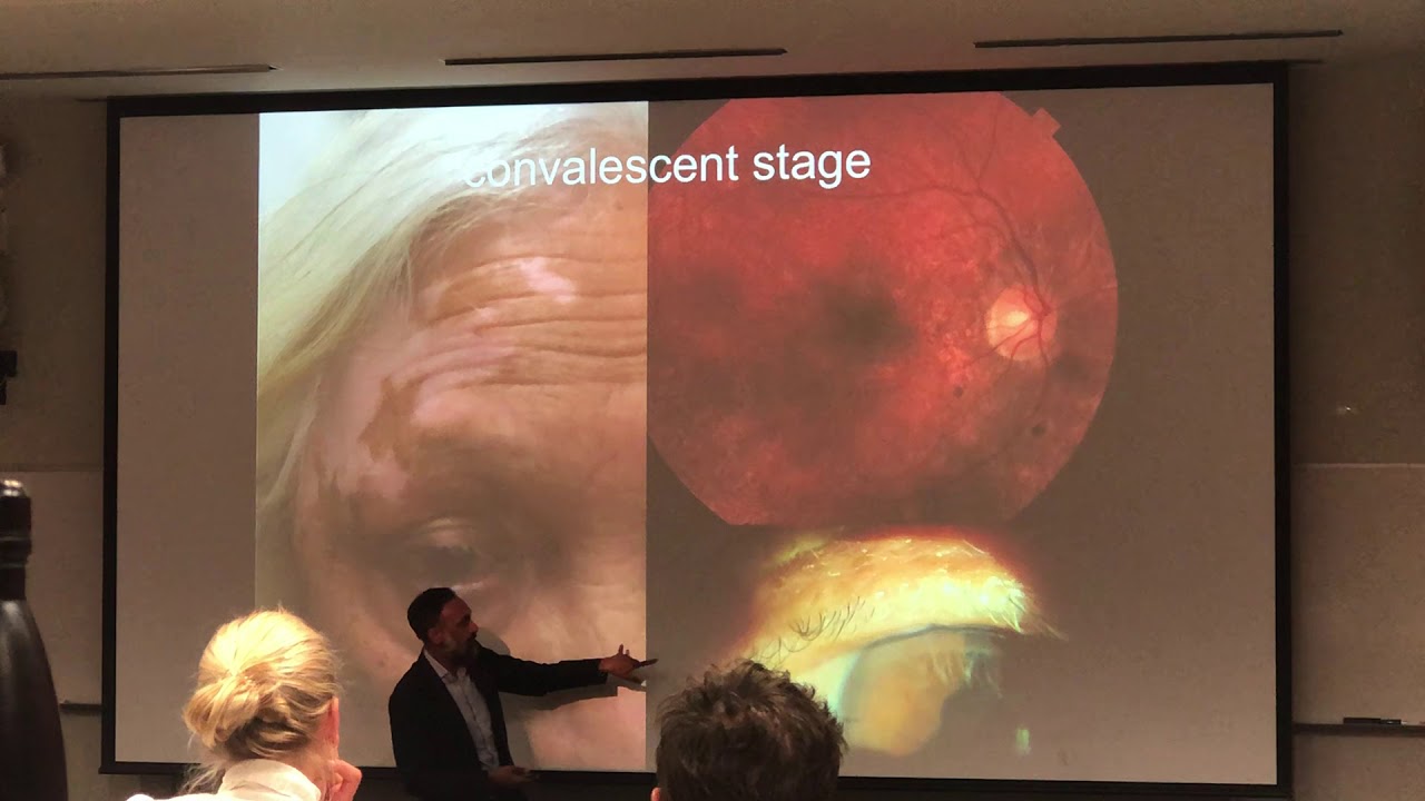 Ocular Manifestations of Selected Autoimmune Diseases Dr Sanjay Kedhar