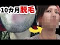 【永久脱毛】メンズリゼでレーザー脱毛したらこうなる！
