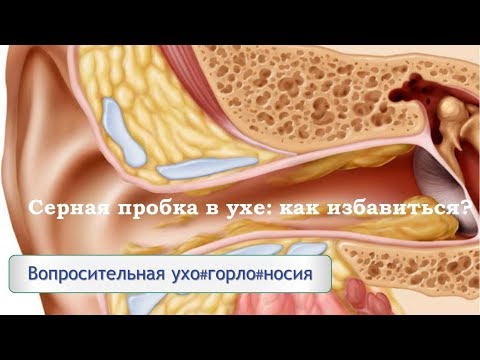 Серная пробка в ухе: как избавиться?