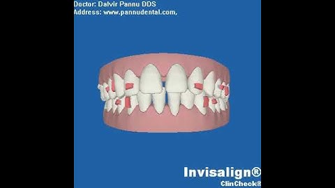 VM Clincheck Invisalign
