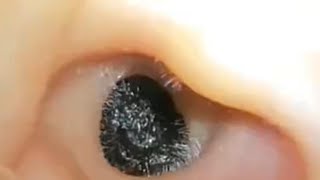 ASMR Ear Cleaning – What on Earth Was Growing Inside This Ear?!