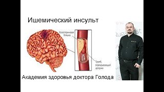 видео: Ишемический инсульт – его виды, проявления и лечение. картинка: Ишемический инсульт – его виды, проявления и лечение.