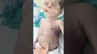 #baby #ventilator #sported #by #gasp #kar #raha #hai #subscribe