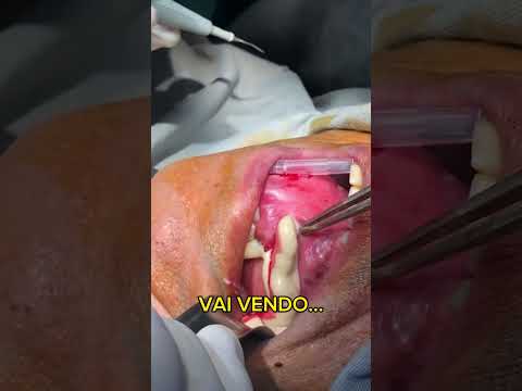 Pus saindo pela boca? O que seria isso? Infecção? Leia os coments! #shorts #odontologia #dentistry