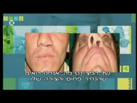 וִידֵאוֹ: למה שפה שסועה גורם?