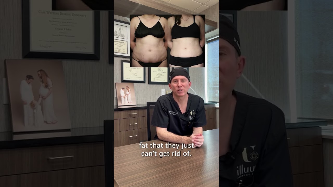 Liposuction vs. High-Def Lipo | Explained by Dr. Lakin