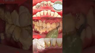 Dental Tartar Dentist New #shorts #2022 screenshot 5