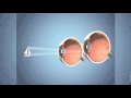 Monovision for presbyopia