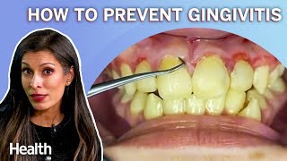 Periodontist Answers YOUR Questions About Bloody Gums, Gingivitis, and Checkups | Ask An Expert