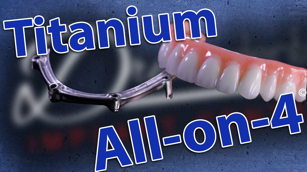 Titanium All on 4 Best dental implants? - Dental Clinic