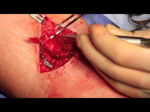 Videó: Arteriovenous Fistula - Tünetek, Kezelés, Formák, Szakaszok, Diagnózis