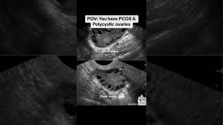 Polycystic ovaries is a common symptom of PCOS