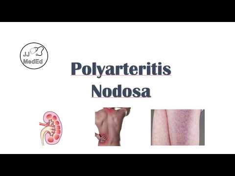 Polyarteritis Nodosa (PAN) | Signs & Symptoms, Diagnosis, Treatment