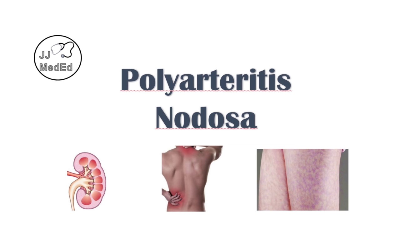 Polyarteritis Nodosa (PAN) Signs & Symptoms, Diagnosis, Treatment