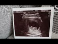 We Are Having a Baby!!! (Telling my husband and family)