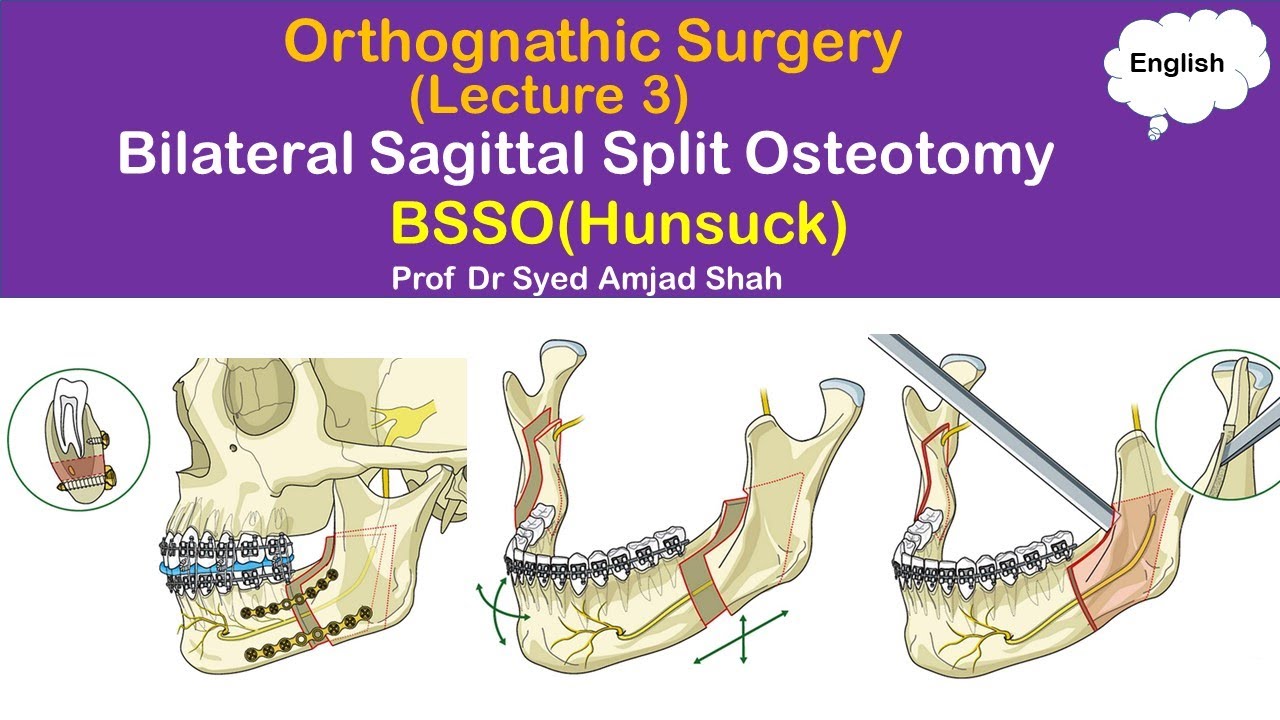 Hunsuck BSSO Bilateral Sagittal Split Osteotomy Orthognathic Hunsuck BSSO Bilateral Sagittal Split Osteotomy Orthognathic