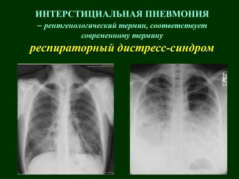 Видео: Видове пневмония при възрастни, деца и новородени: класификация