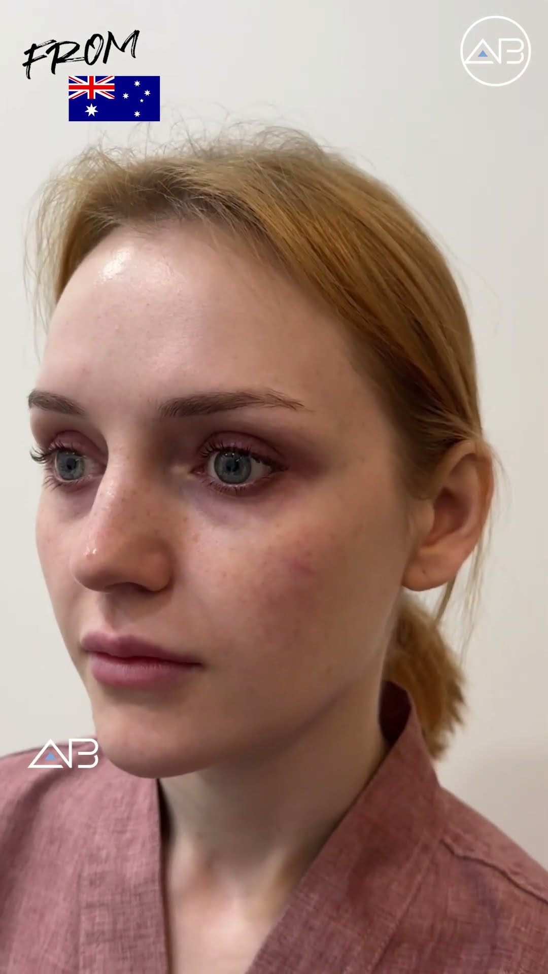 From Tired to Glowing Her Semi Facelift Transformation #shorts