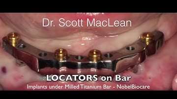 *NEW - Dental Implant Milled Bar Overdenture - Female Stud Attachments Change