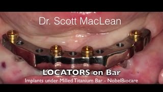 *NEW - Dental Implant Milled Bar Overdenture - Female Stud Attachments Change