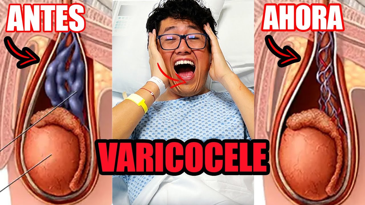 Operación De Varicocele En El Imss