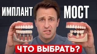 Зубной мост или имплант - что выбрать? Плюсы и минусы