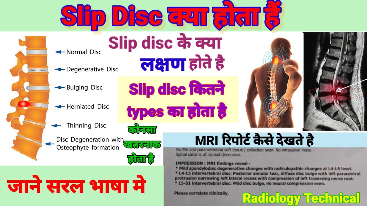 Slip Disc क्या होता है लक्षण Slip disc कितने types की होती है MRI