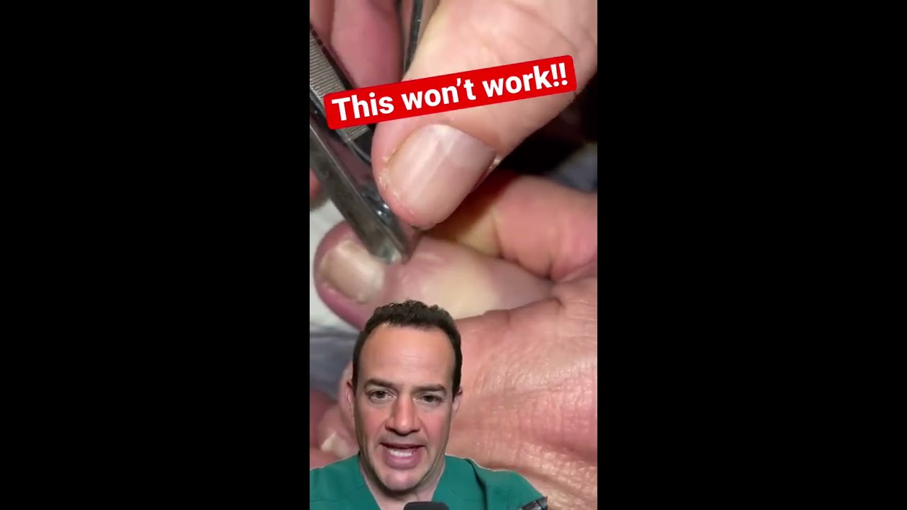 DOCTOR REACTS HOW TO NOT REMOVE AN INGROWN TOENAIL Shorts