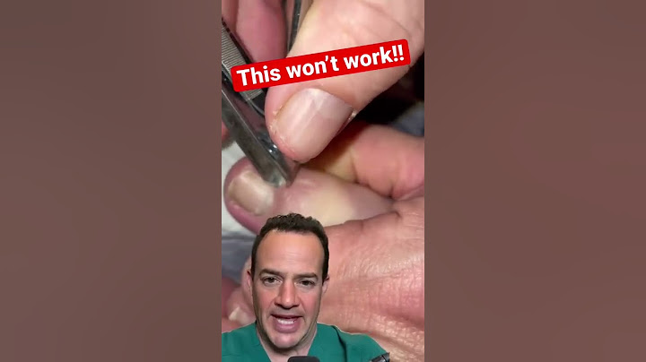 DOCTOR REACTS: HOW TO NOT REMOVE AN INGROWN TOENAIL! #shorts