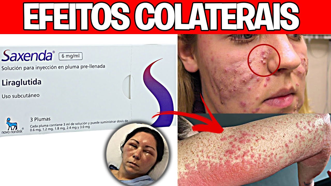 🔴CUIDADO😱 É ASSIM QUE A SAXENDA AGE NO ORGANISMO | ANTES E DEPOIS ...