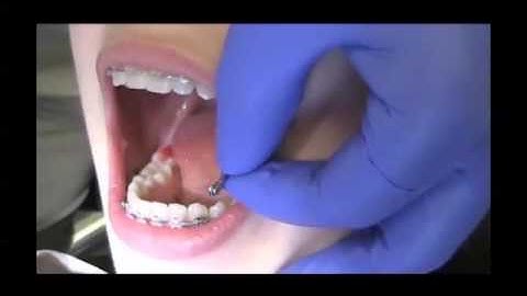 BioBite Correct (BBC) | Dentsply Sirona