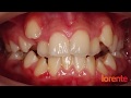 CASO REAL 25. Paciente con brackets metálicos. Antes-después image