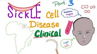 Sickle Cell Disease “part 3”: Clinical Picture