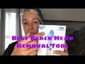 Best blackhead removal tool | Review